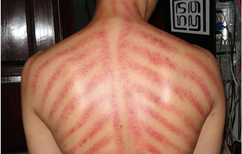 Kerokan dengan Uang Logam Itu Aman atau Tidak?